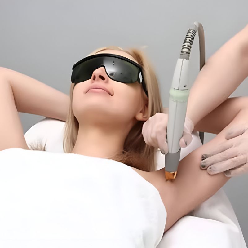 laser hair reduction