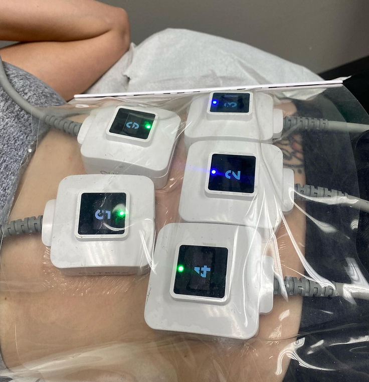 imgi_24_Trusculpt ID procedure