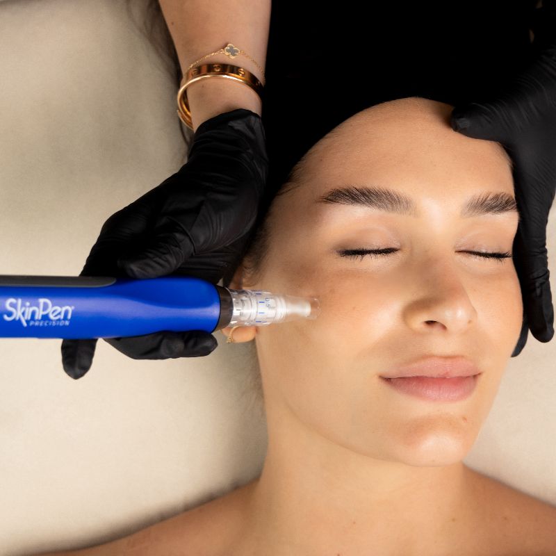 microneedling